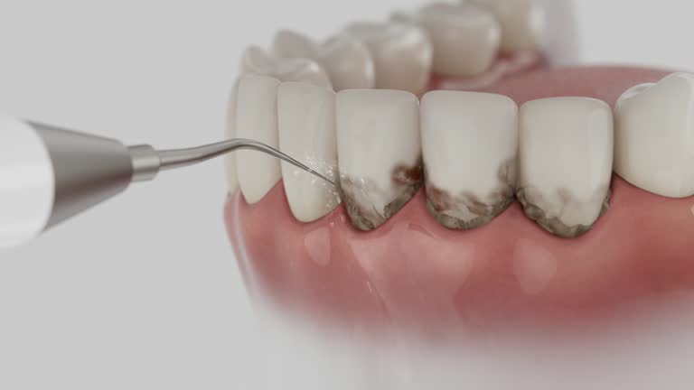Trusted Wisdom Tooth Removal service in Lacy-Lakeview, TX - Dentist Open Now